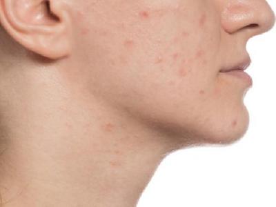 面癱要怎樣治療效果好恢復快 中醫教你自我按摩輕松治療面癱