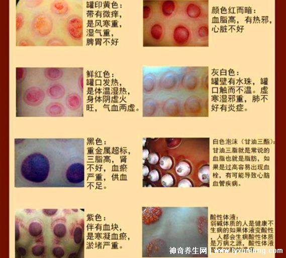 拔罐顏色癥狀對照表，紅色/黃色/藍色代表各不同(顏色深淺圖解)
