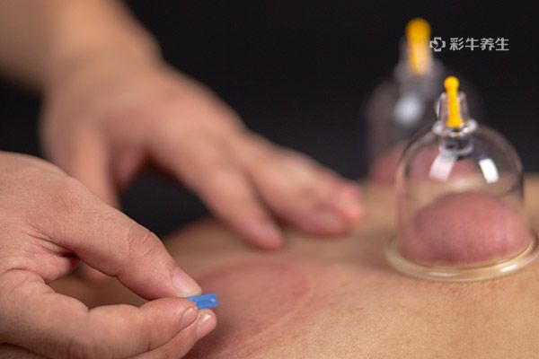 拔罐多久一次合適-易網健康養生網 拔罐多久一次合適