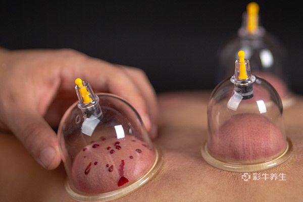 拔罐多久一次合適-易網<a href=http://www.xllyou.com/ target=_blank class=infotextkey>健康養生</a>網 拔罐多久一次合適