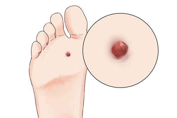 什么是涌泉穴-易網<a href=http://www.xllyou.com/ target=_blank class=infotextkey>健康養生</a>網 什么是涌泉穴